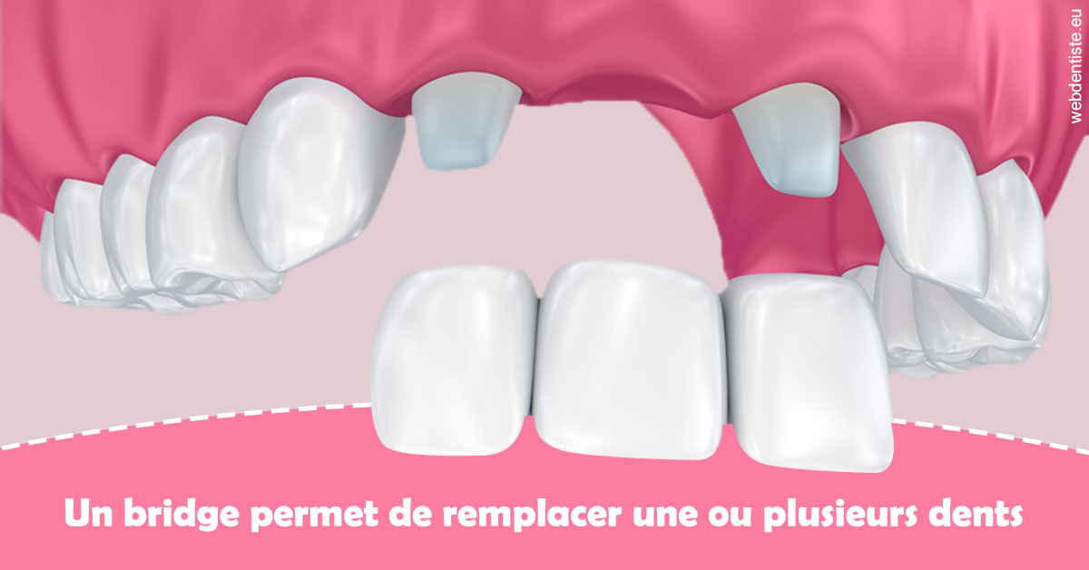 https://dr-boyer-sophie.chirurgiens-dentistes.fr/Bridge remplacer dents 2