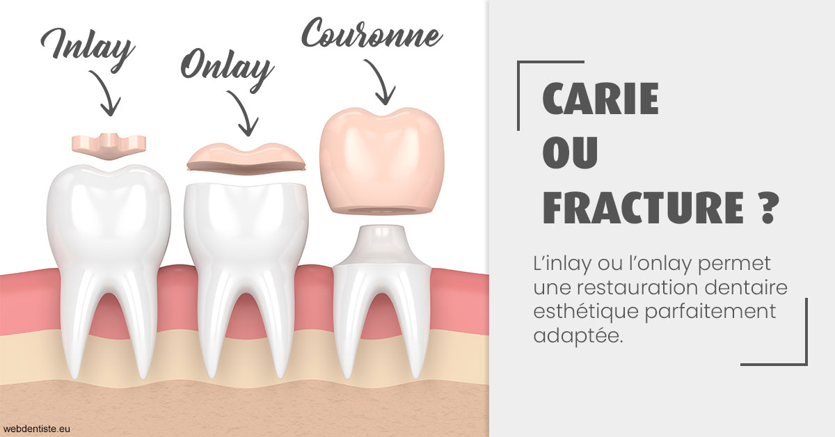https://dr-boyer-sophie.chirurgiens-dentistes.fr/T2 2023 - Carie ou fracture 1