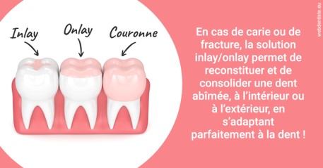 https://dr-boyer-sophie.chirurgiens-dentistes.fr/L'INLAY ou l'ONLAY 2