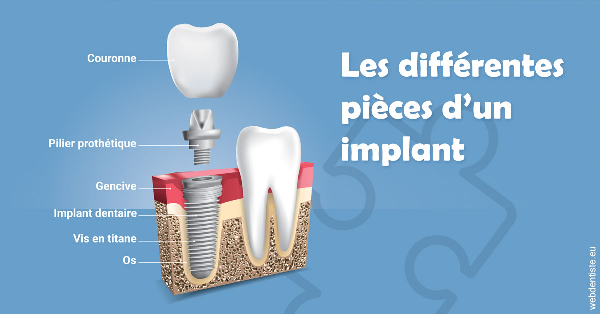https://dr-boyer-sophie.chirurgiens-dentistes.fr/Les différentes pièces d’un implant 1